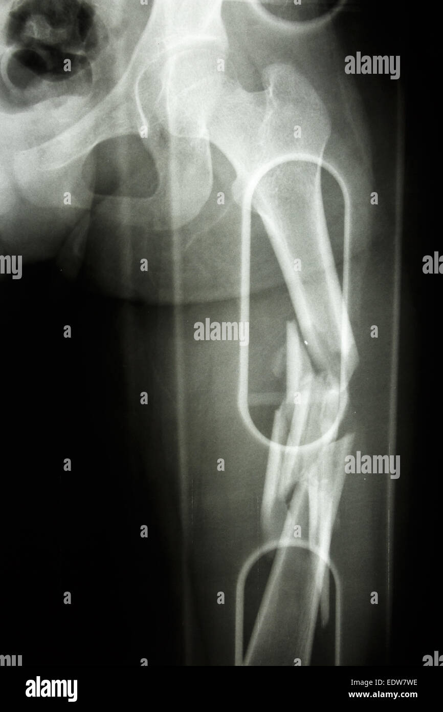 Film X-ray afficher l'arbre de fémur fracture comminute Banque D'Images
