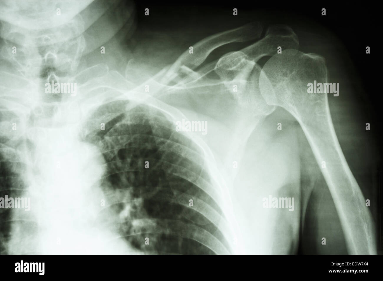 Film X-ray show fracture comminutive du milieu dans le troisième à gauche clavile Banque D'Images