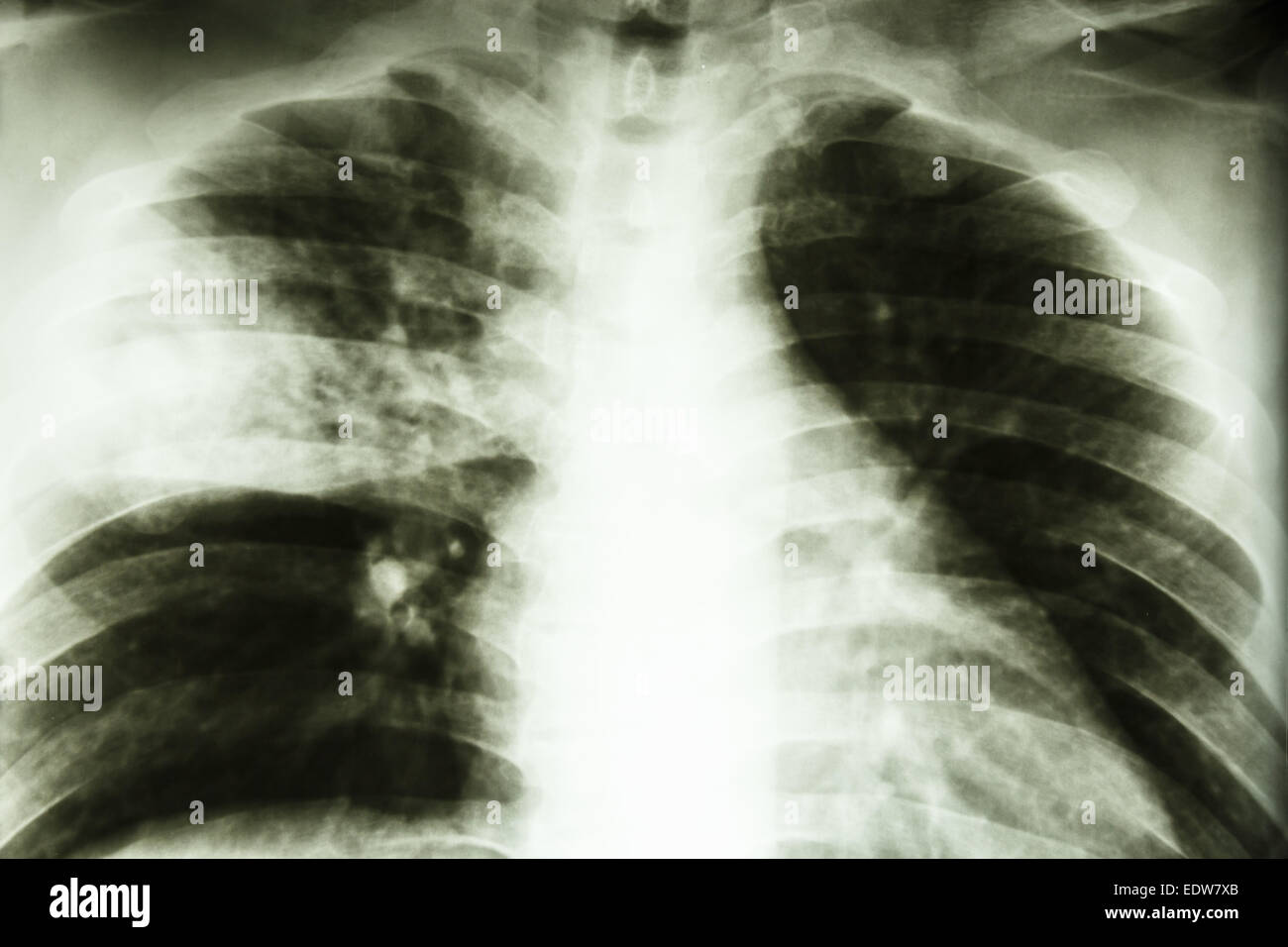 Film X-ray show inégal infiltrer au milieu droit (pulmonaire pneumonie lobaire) de Mycobacterium tuberculosis infection pulmonaire (à remous Banque D'Images