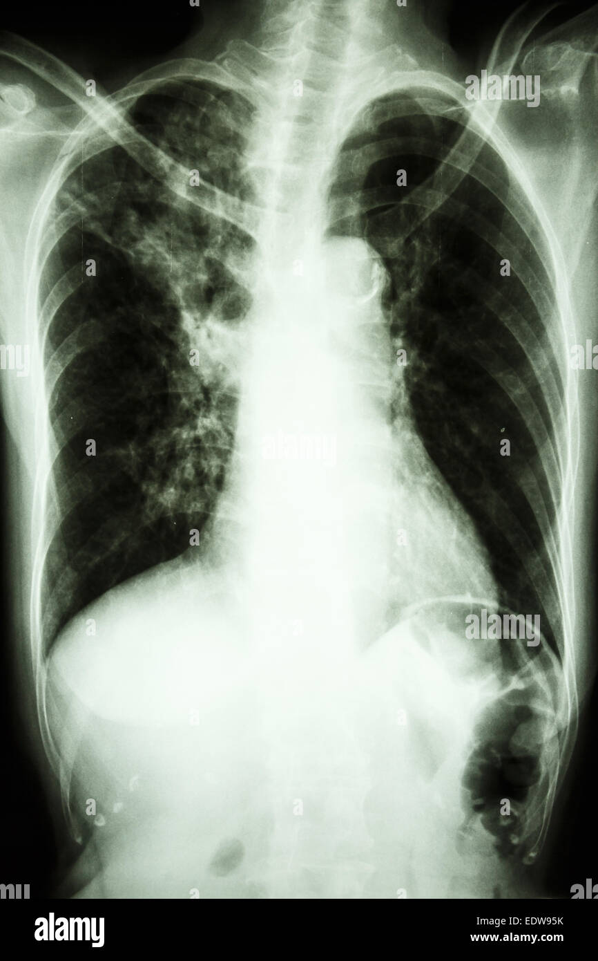 Film radiographie de la PA en position verticale montrent à infiltrer interstitielle pulmonaire supérieure droite 'mycobacterium tuberculosis en raison d''infection (Pulm Banque D'Images