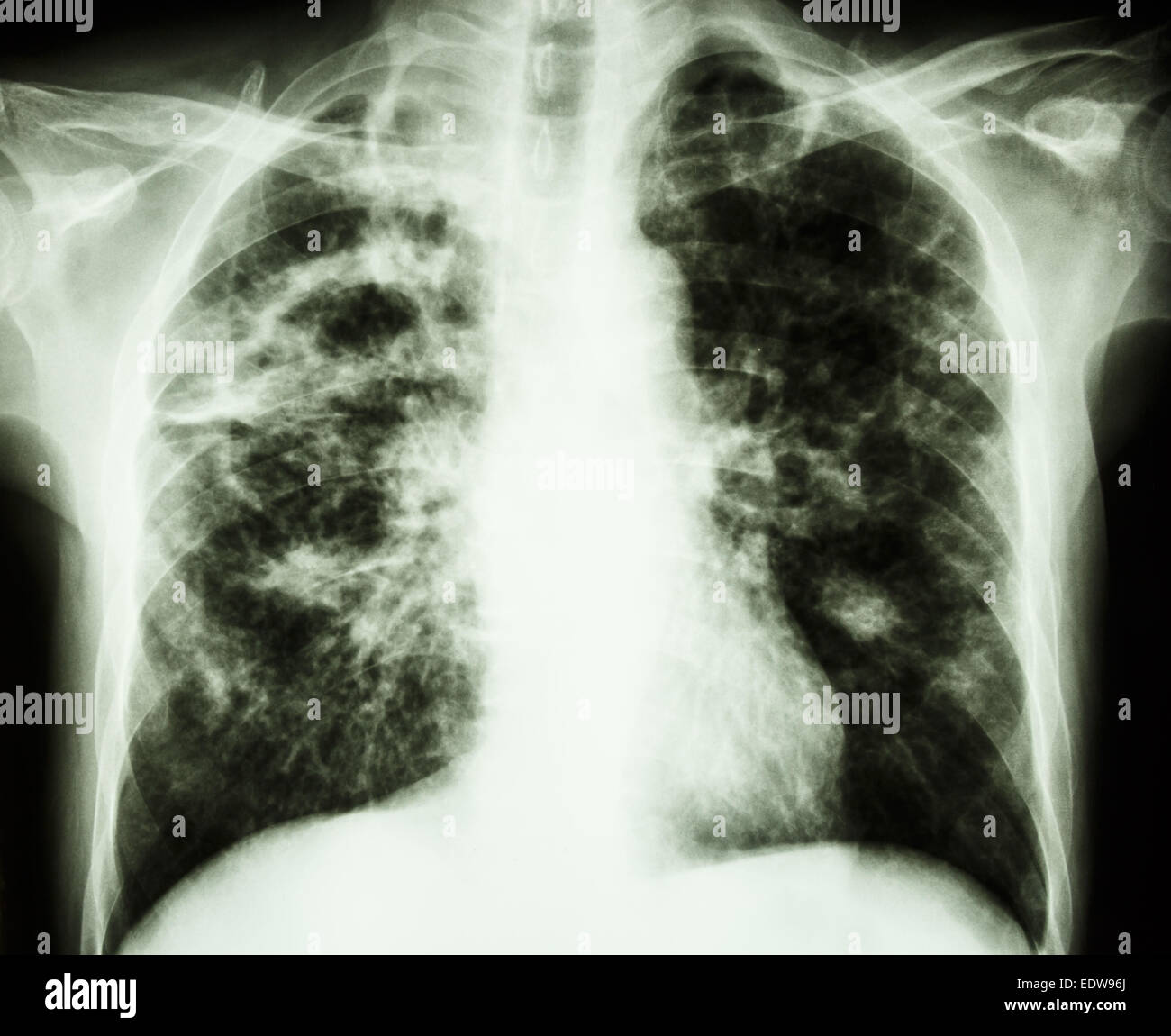 Film radiographie du poumon droit à montrer une fibrose interstitielle,& & parcellaires infiltrer aux deux poumons due à Mycobacterium tubercu Banque D'Images