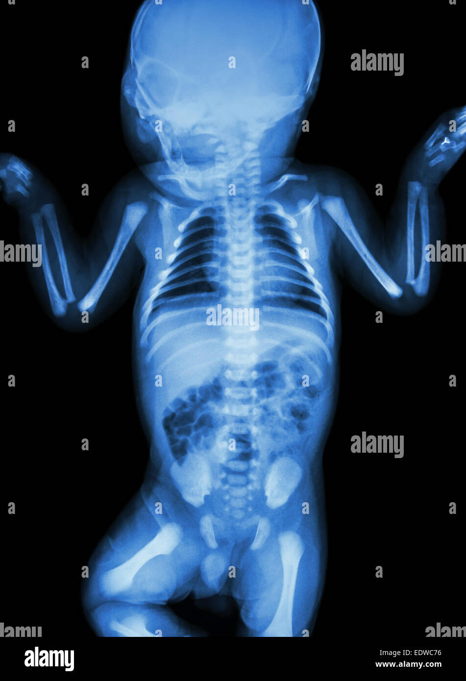 Film x-ray ensemble corps du bébé Banque D'Images