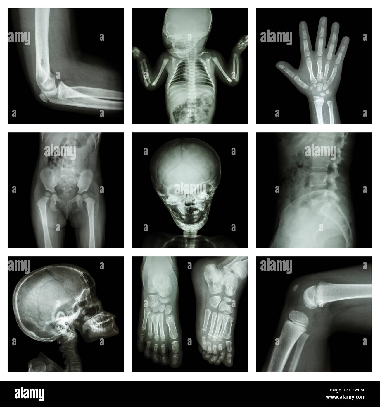 Radiographie de bébé Banque de photographies et d'images à haute résolution  - Alamy