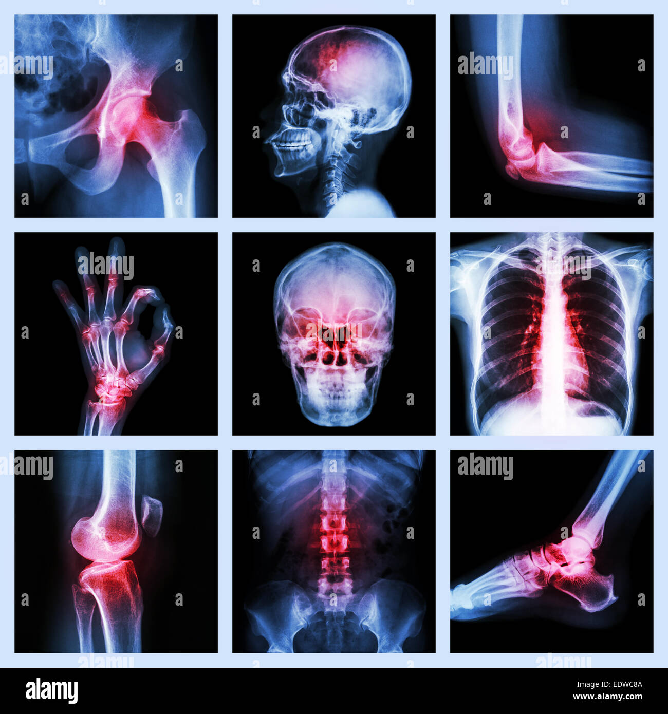 Collection X-ray et blessures multiples Banque D'Images