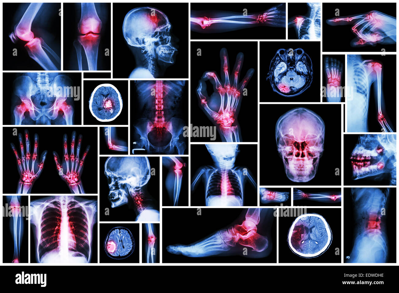 X-ray plusieurs partie de la avec de multiples maladies (accident vasculaire cérébral, l'arthrite, la goutte, le rhumatisme, tumeur au cerveau, l'arthrose, etc.) Banque D'Images
