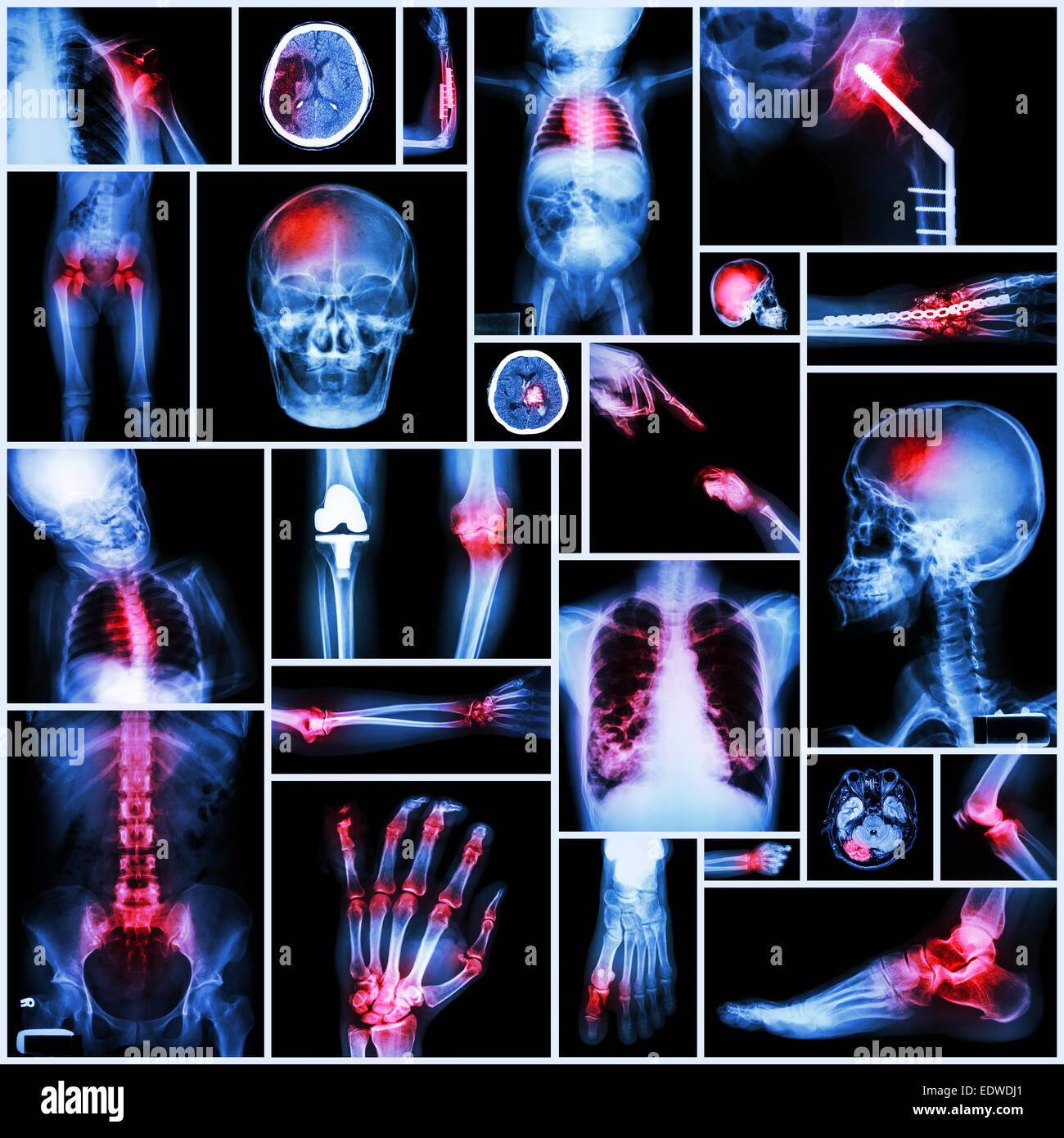 Collection de X-ray plusieurs partie de l'opération orthopédique,et plusieurs maladies (luxation de l'Épaule Fracture,course,de,la goutte, Banque D'Images