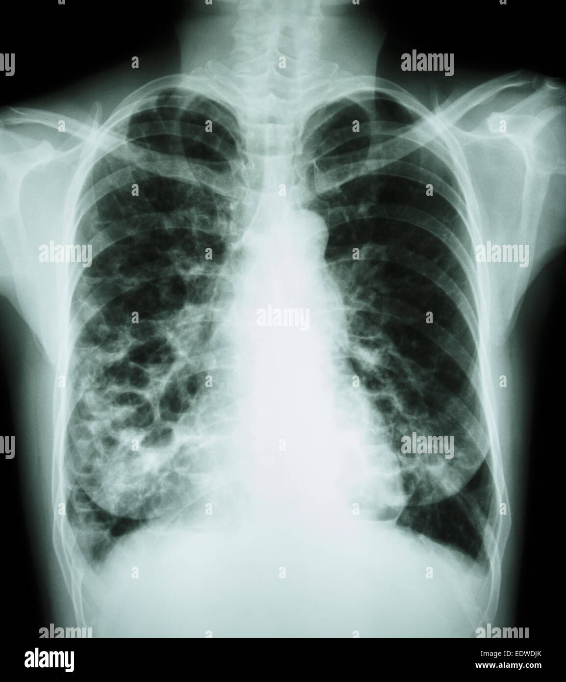 La Bronchiectasie' 'X-ray show : Poitrine de multiples kystes pulmonaires bleb et en raison de l'infection chronique Banque D'Images