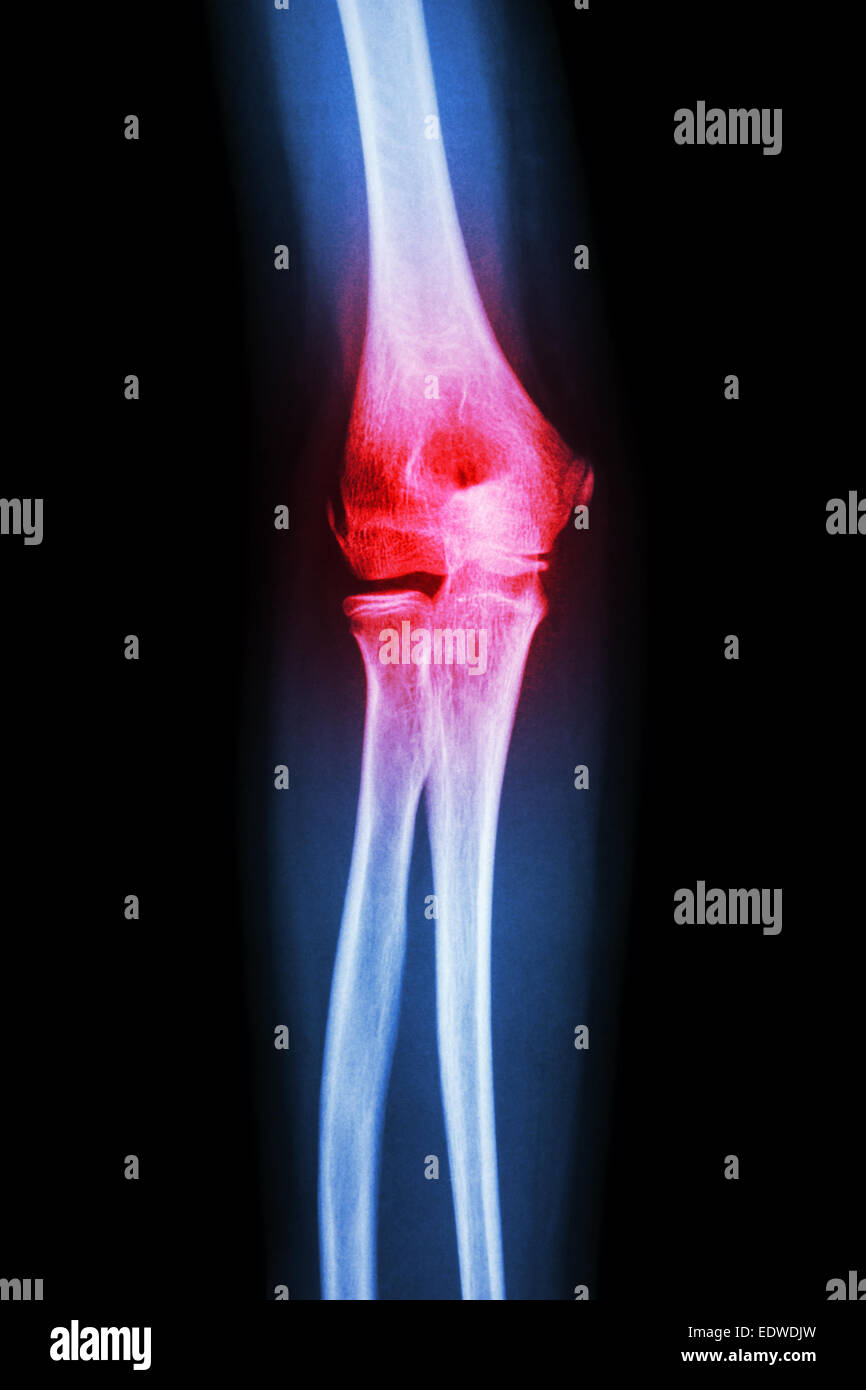 Des rayons-X et de l'arthrite du coude (la goutte, le rhumatisme) Banque D'Images