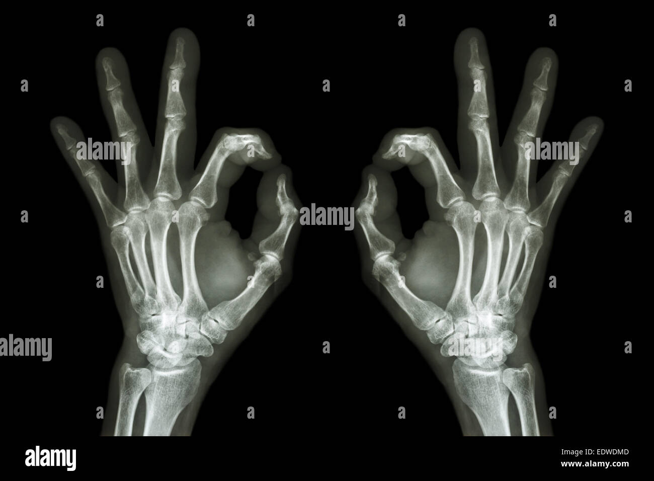 X-ray mains avec OK sign Banque D'Images