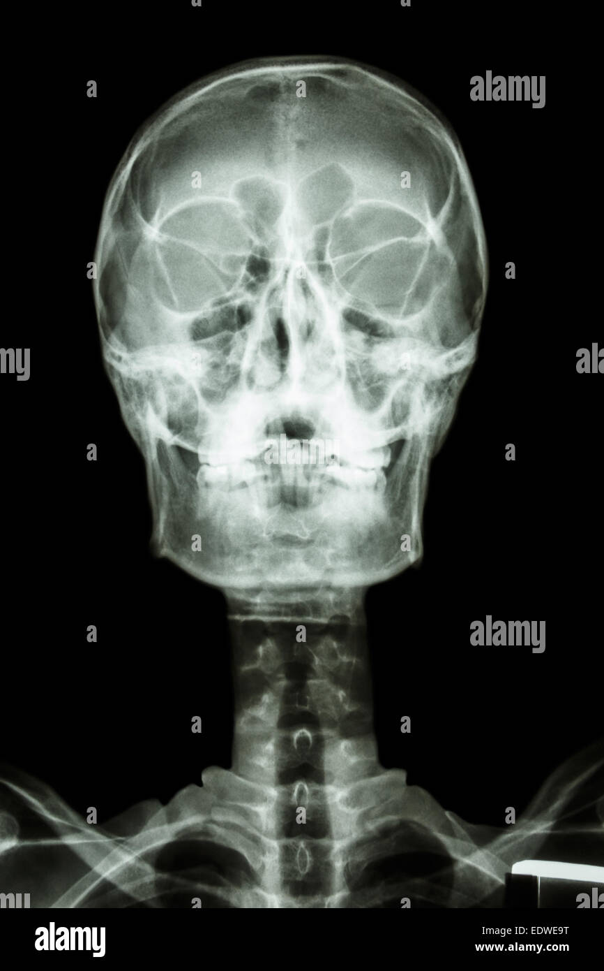 Film x-ray : le crâne humain normal et rachis cervical Banque D'Images