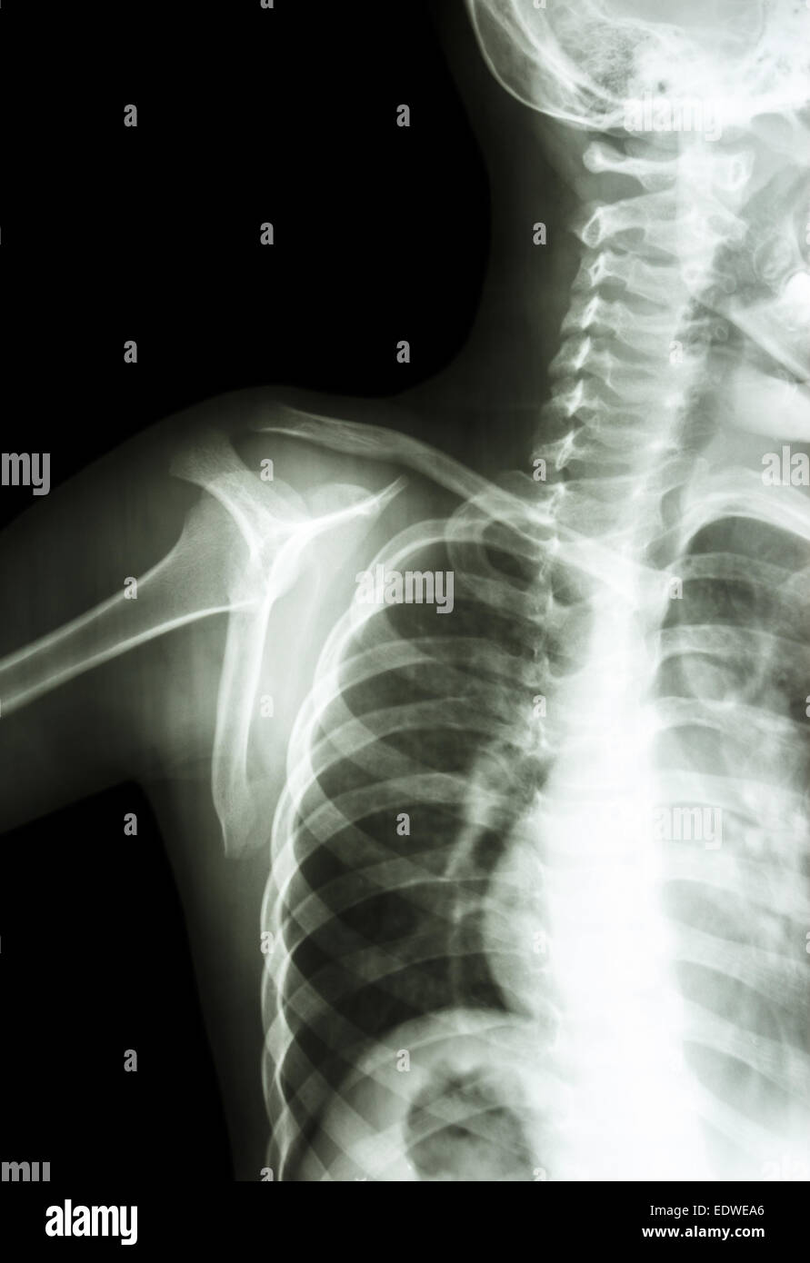 Film x-ray transcapula y voir : montrer l'épaule de l'enfant normal Banque D'Images