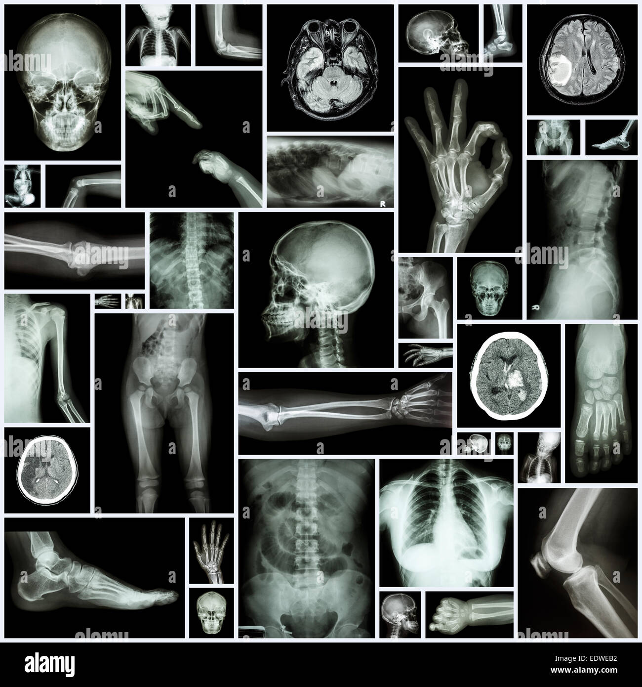 X-ray partie multiples des droits de Banque D'Images