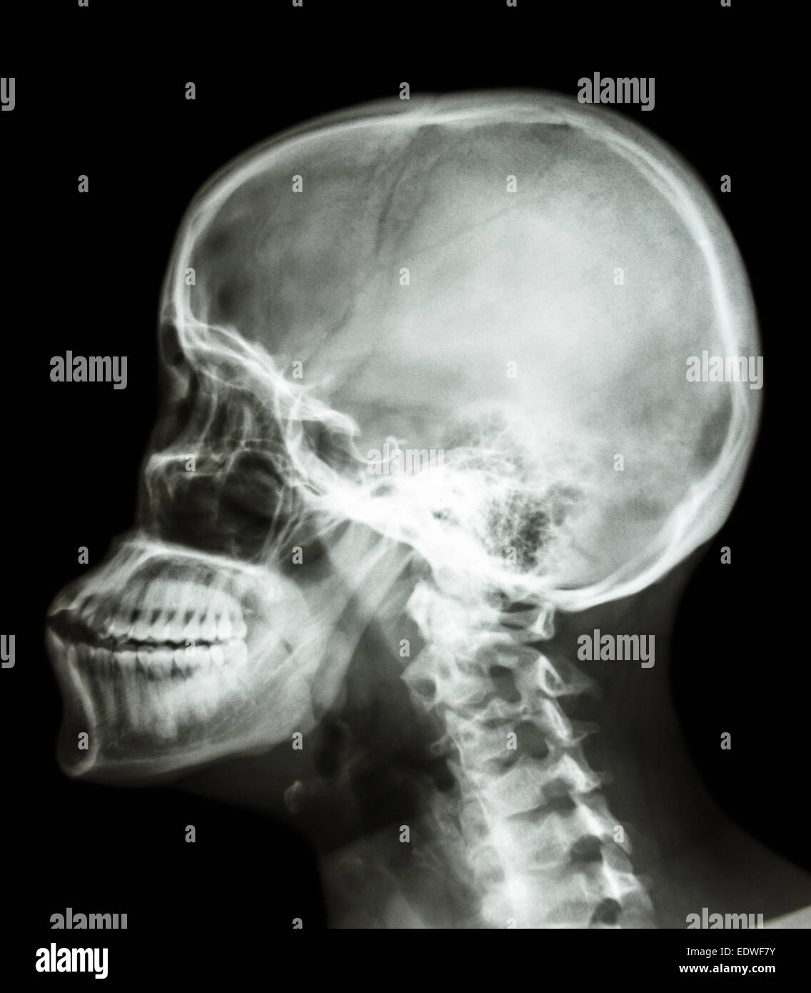 Film x-ray latérale crâne : le crâne humain montrer et rachis cervical Banque D'Images
