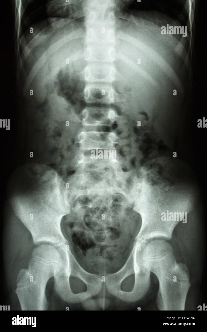 Film x-ray afficher la colonne vertébrale de l'enfant, abdomen, pelvis hanche , Banque D'Images