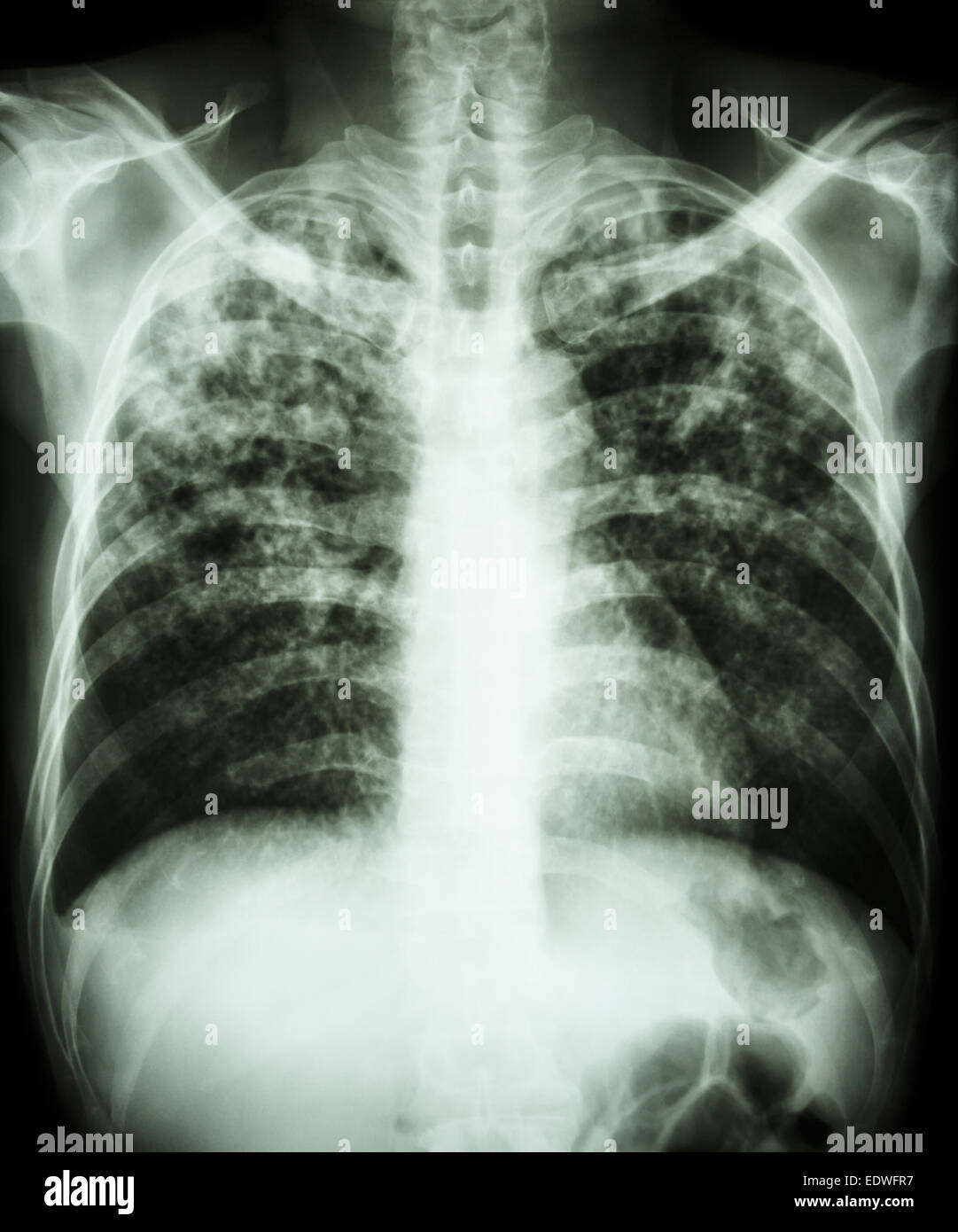 Le film 'La tuberculose pulmonaire La radiographie pulmonaire infiltration  interstitielle montrent à la fois en raison de l'infection à Mycobacterium  tuberculosis Photo Stock - Alamy