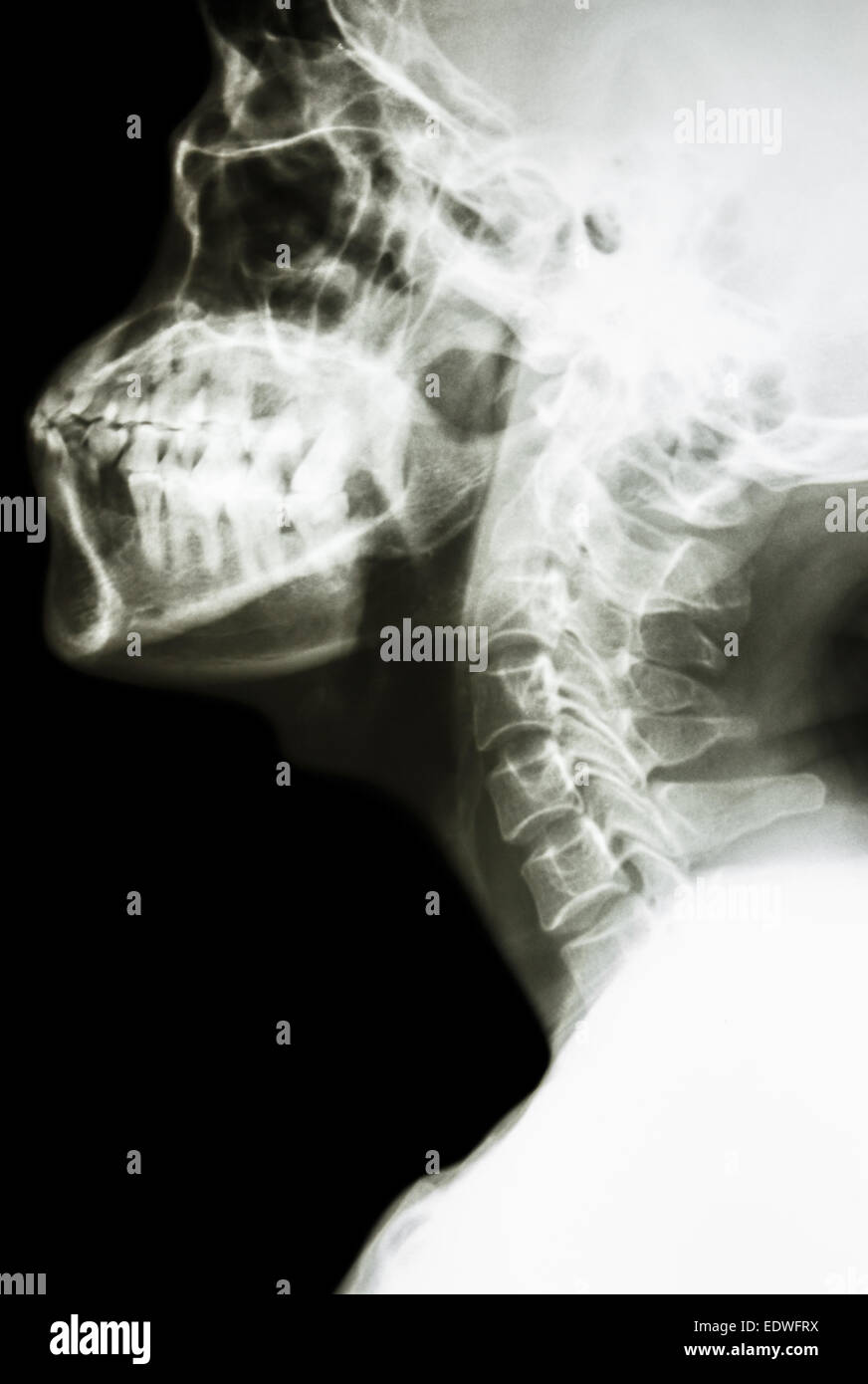 Film x-ray latéral de la colonne cervicale normale : spectacle de l'homme thaïlandais rachis cervical Banque D'Images