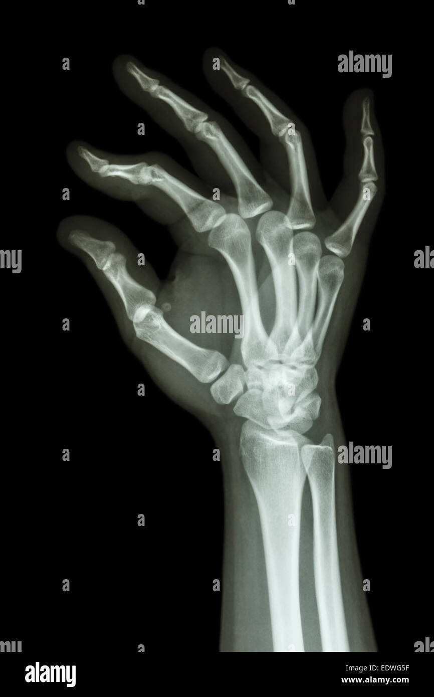 Film x-ray la main de l'homme et symbole OK Banque D'Images