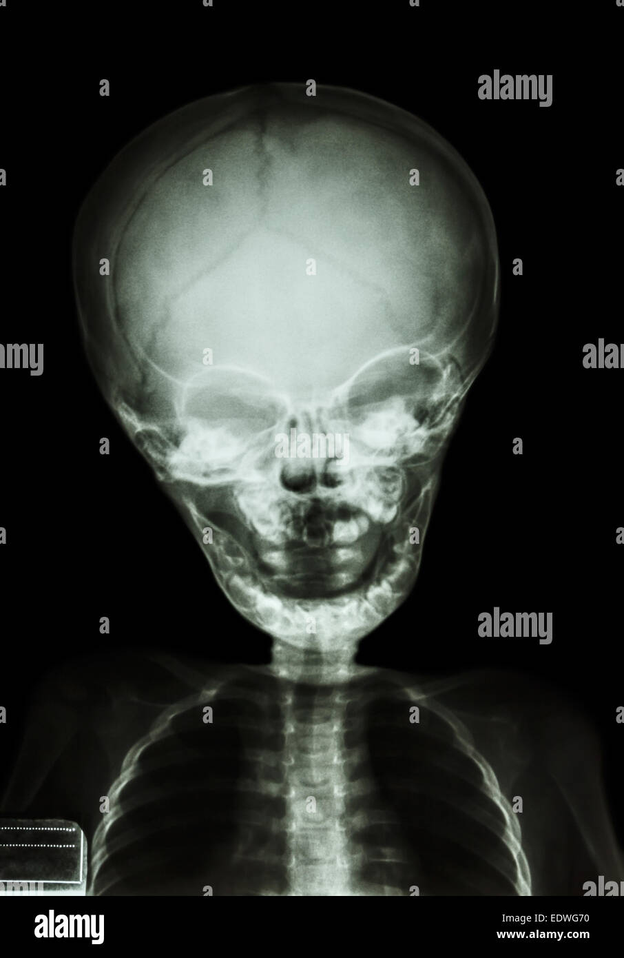 Film x-ray le crâne et corps d'enfant Banque D'Images