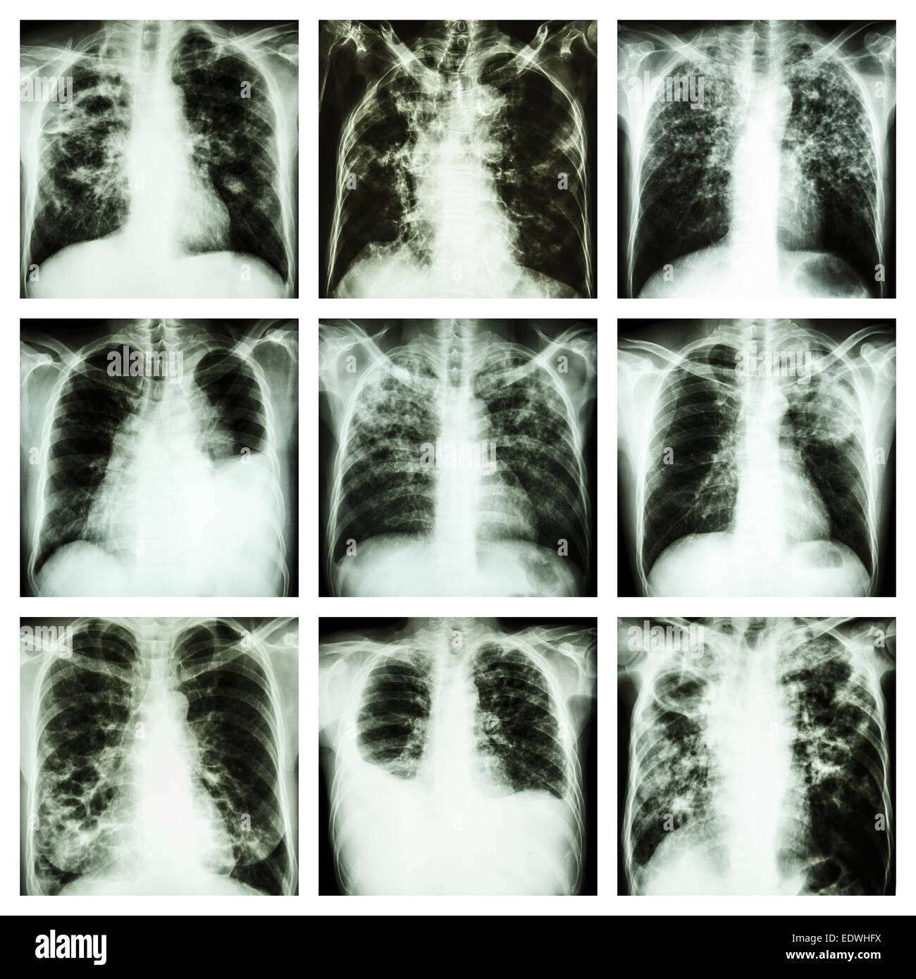 Collection de maladies pulmonaires (tuberculose pulmonaire, épanchement pleural, la bronchiectasie) Banque D'Images