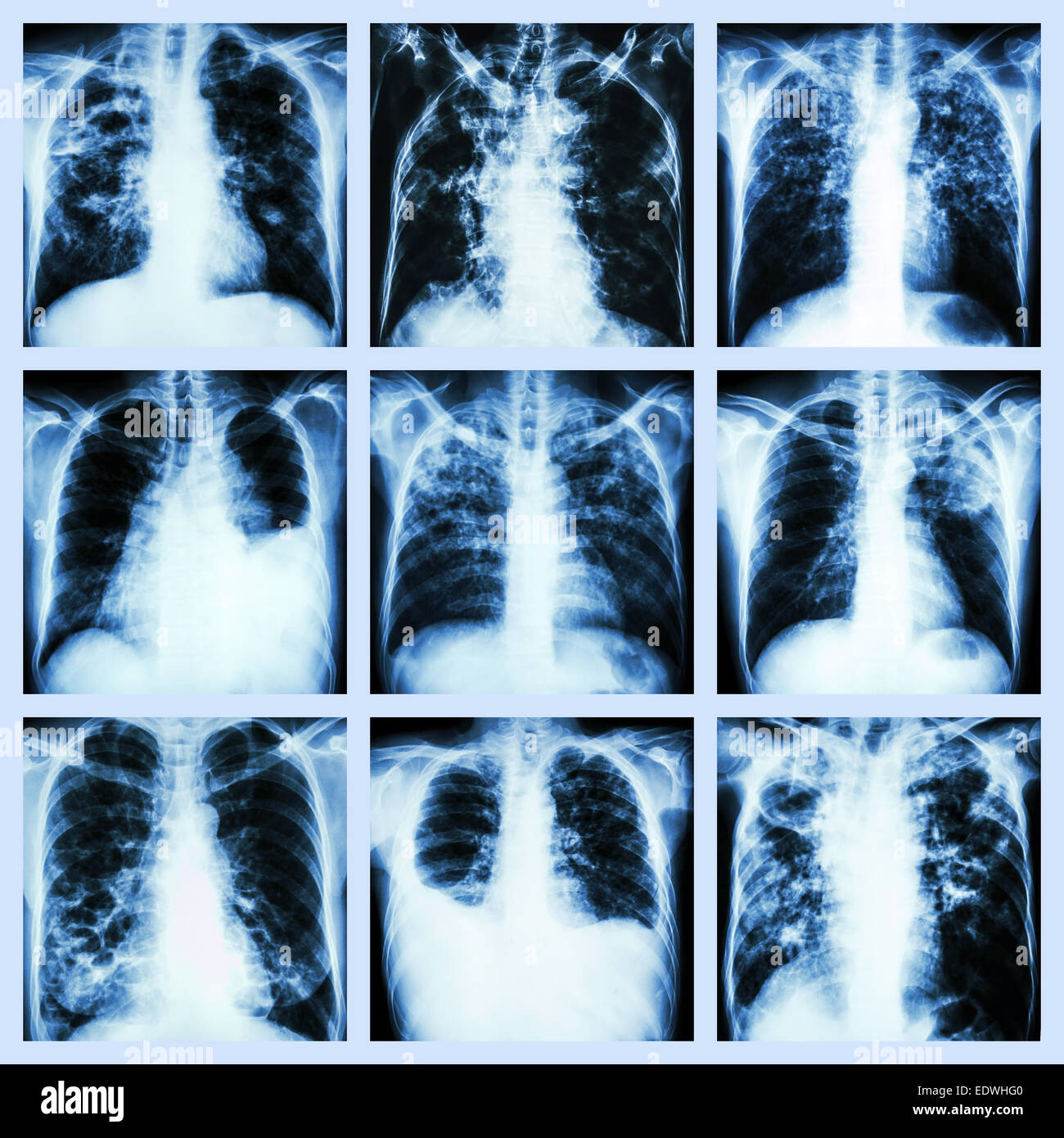 Collection de maladies pulmonaires (tuberculose pulmonaire, épanchement pleural, la bronchiectasie) Banque D'Images