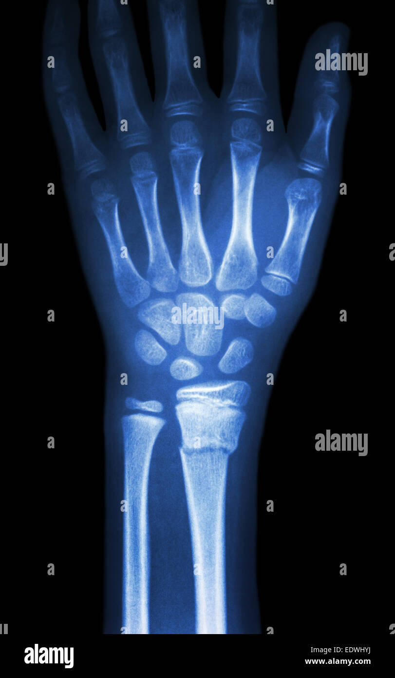 Fiilm x-ray show poignet du radius distal (fracture des os de l'avant-bras) Banque D'Images