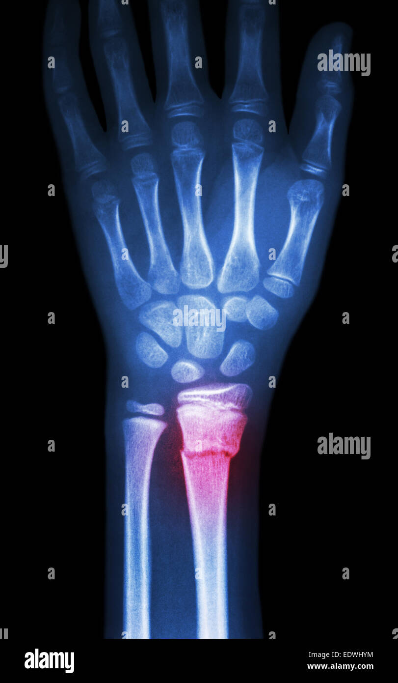 Fiilm x-ray show poignet du radius distal (fracture des os de l'avant-bras) Banque D'Images