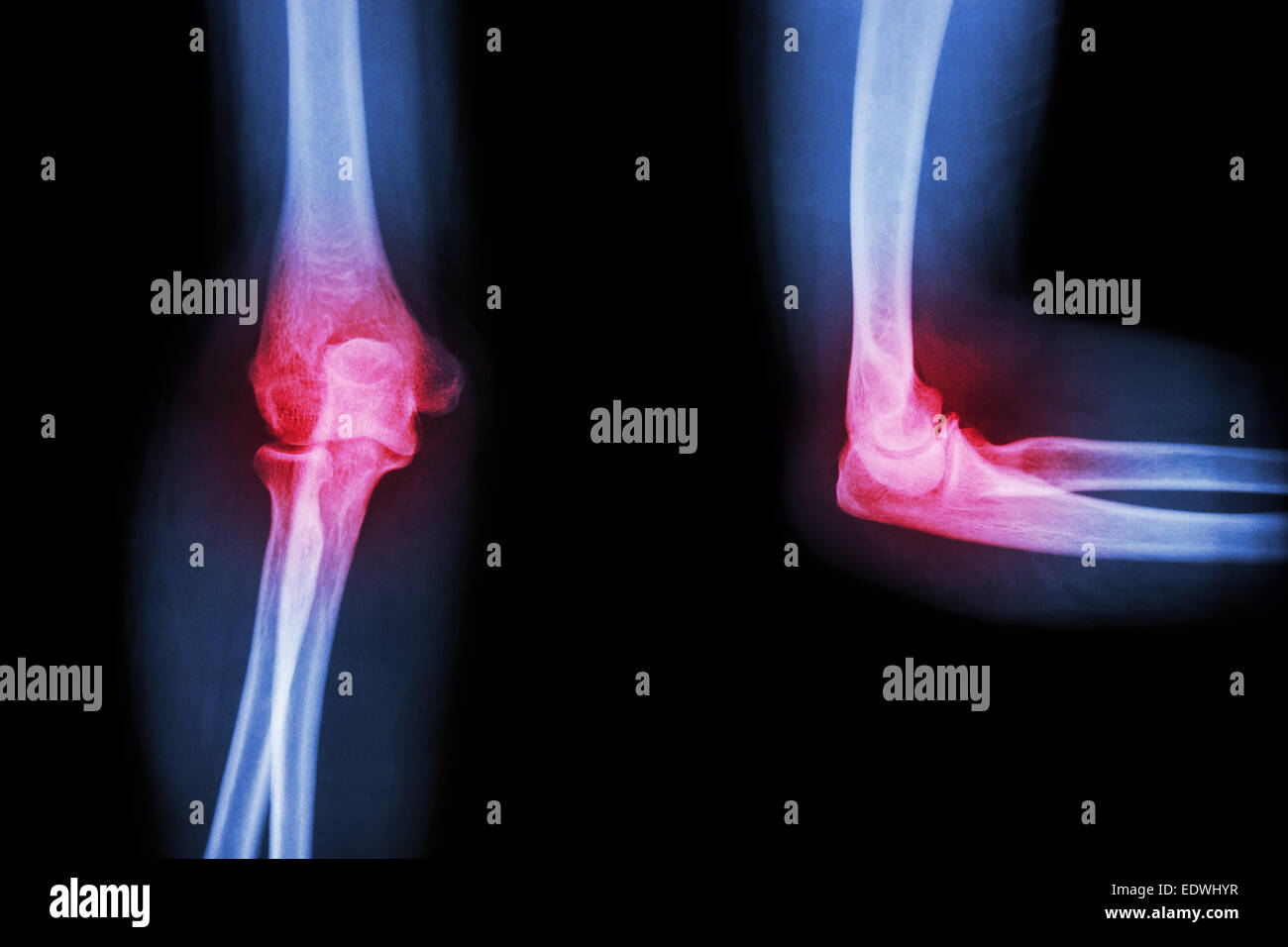 Film X-ray le coude avec de l'arthrite rhumatoïde (goutte), Banque D'Images