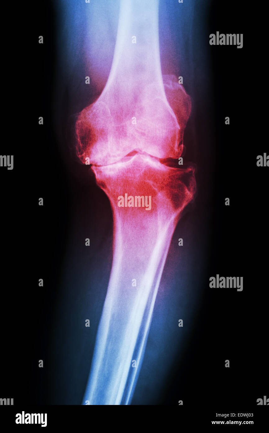 Film x-ray AP GENOU Arthrose du genou du patient (OA) Banque D'Images