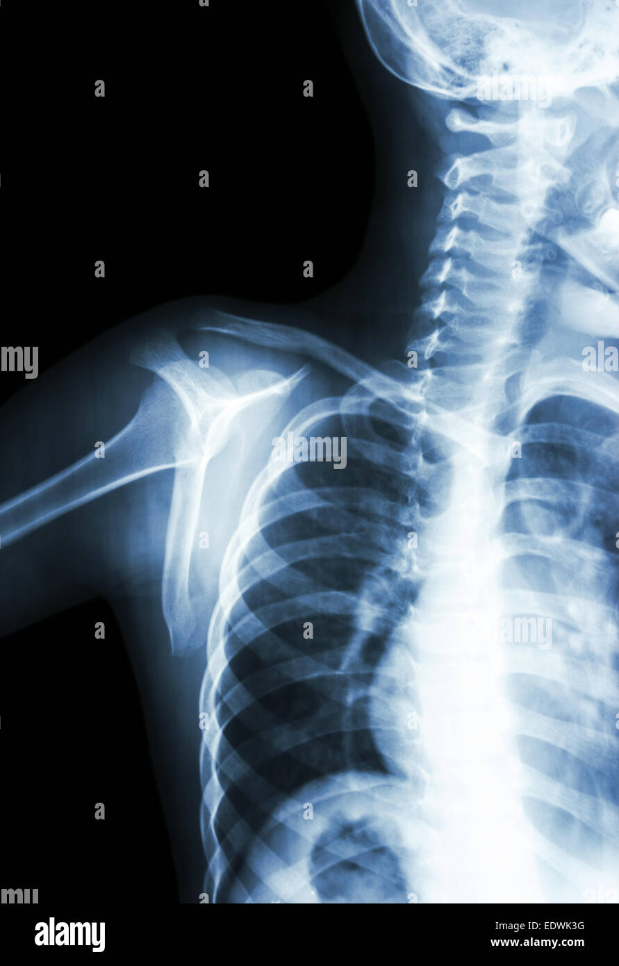 Film x-ray transcapula y voir : montrer l'épaule de l'enfant normal Banque D'Images