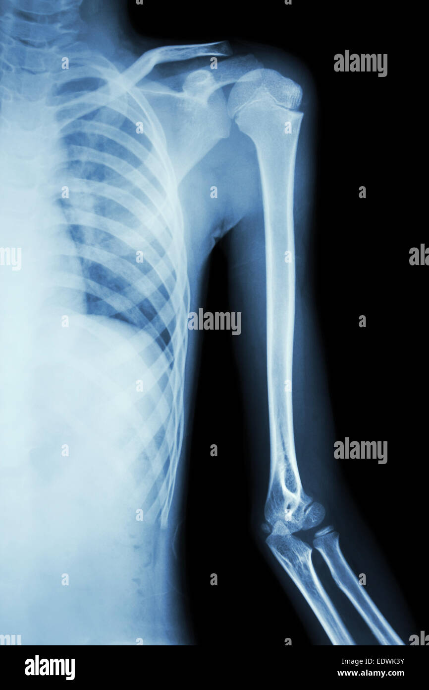 Film x-ray à l'épaule gauche Banque D'Images