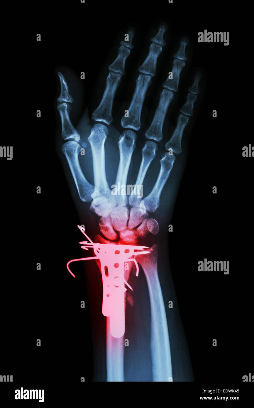 Film x-ray AP : fracture du poignet montre la partie distale du radius (os d'avant-bras). Il a été exploité et plaque insérée et K-wire(fil Kirschner Banque D'Images