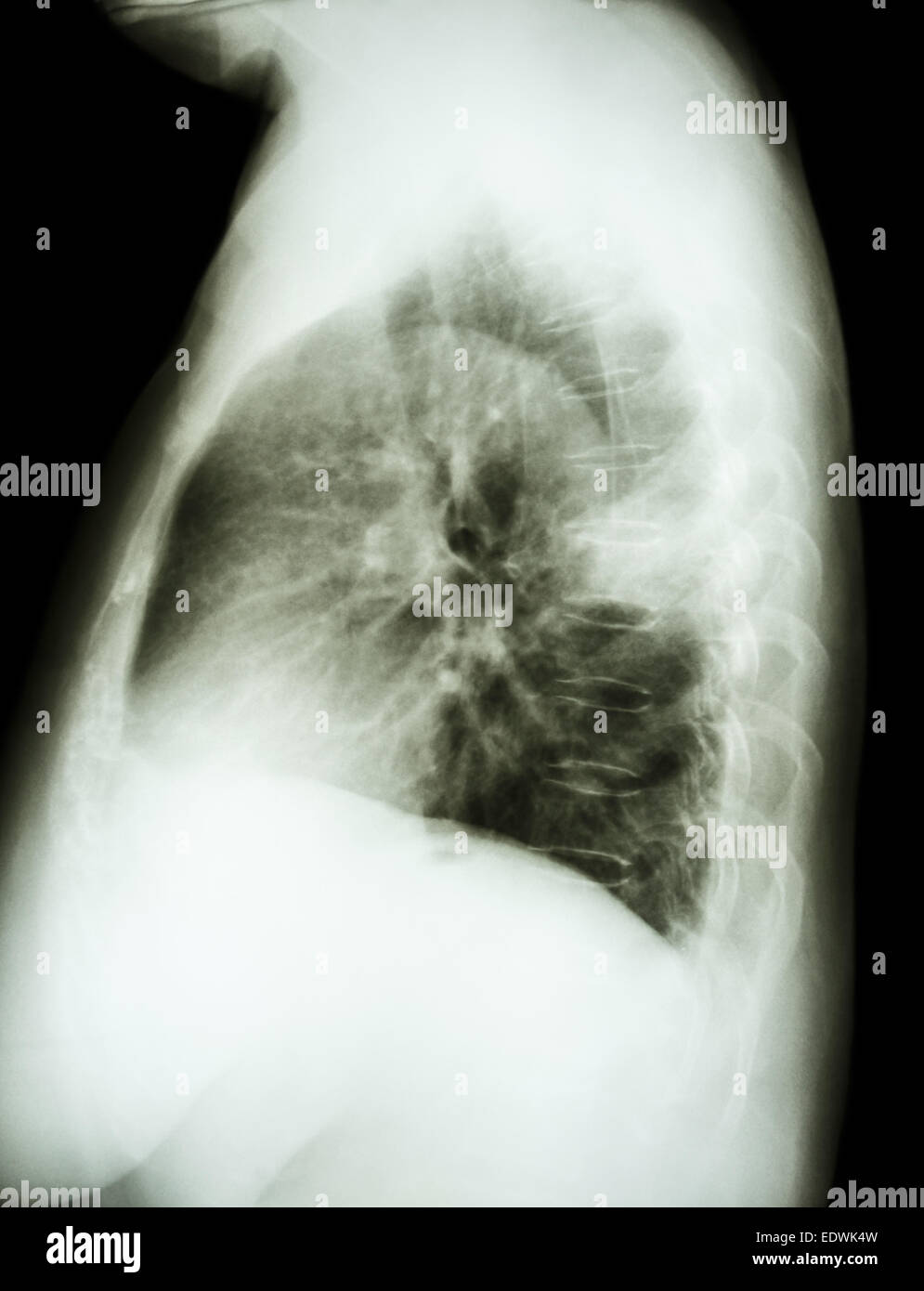 X-ray latérale de la poitrine du patient de cancer du poumon Banque D'Images