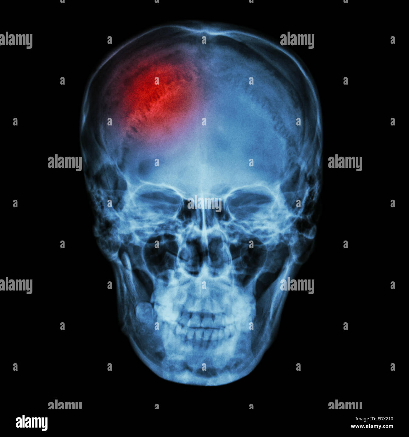 X-ray crâne asiatiques (Thaïs) et maux de tête Banque D'Images