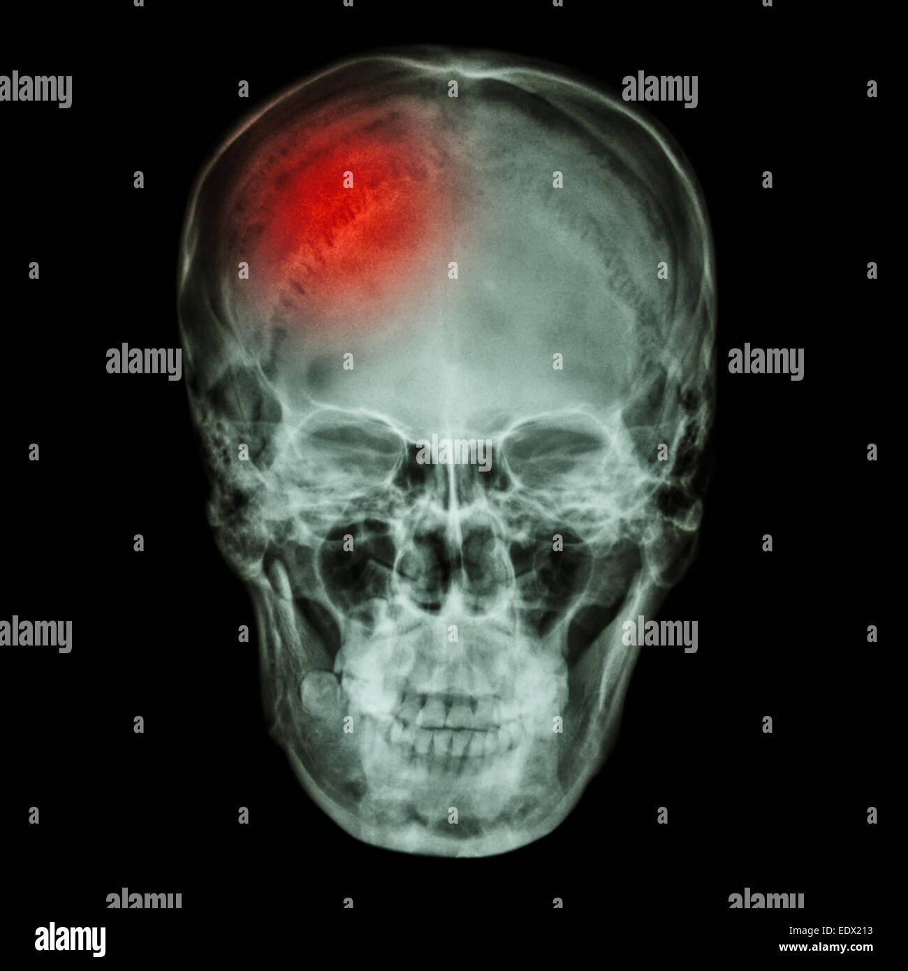 X-ray crâne asiatiques (Thaïs) et maux de tête Banque D'Images