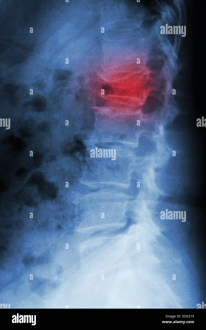 Film x-ray latérale de la colonne lombaire : show burst fracture à la colonne vertébrale lombaire (effondrement à corps de colonne lombaire) Banque D'Images