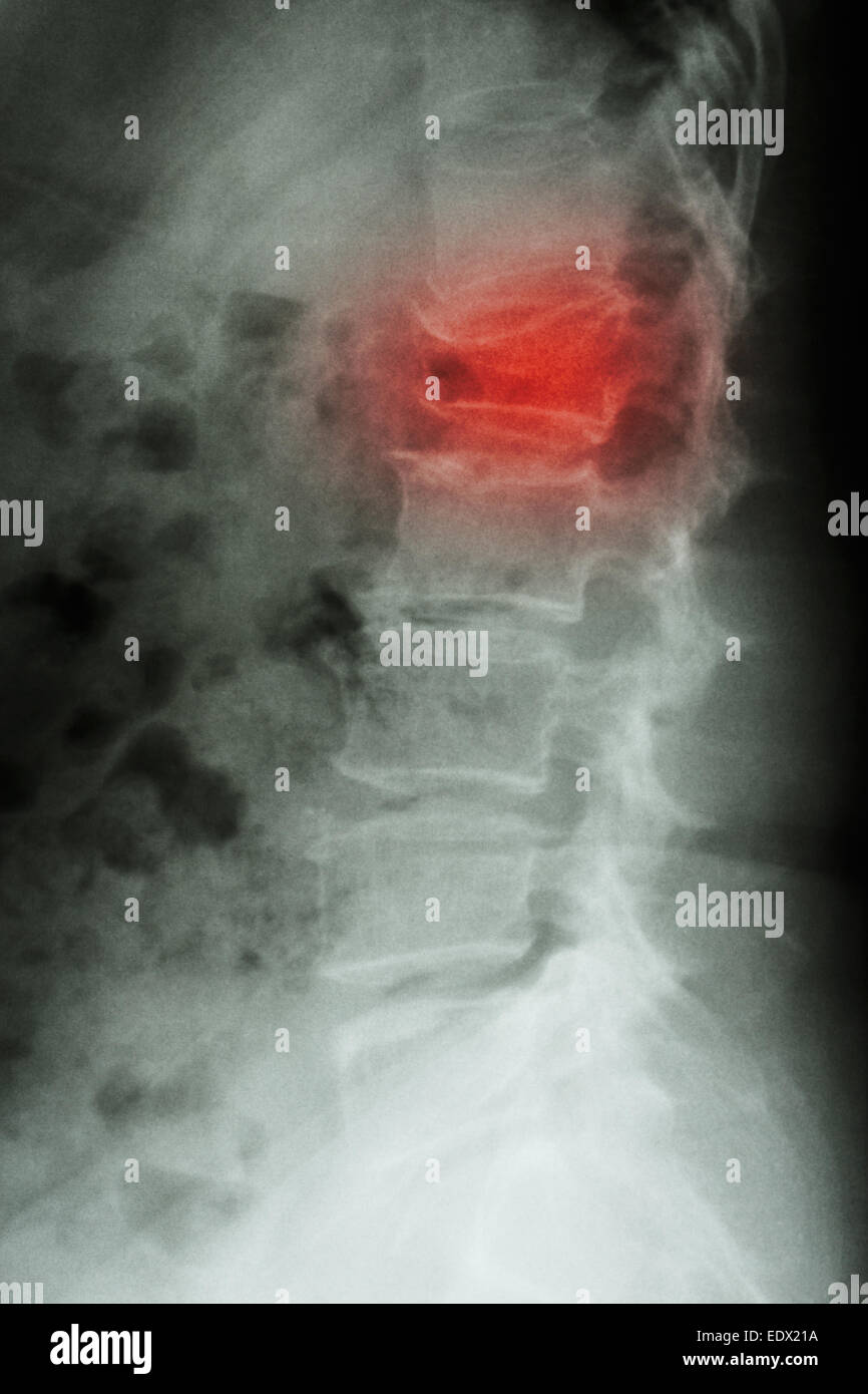 Film x-ray latérale de la colonne lombaire : show burst fracture à la colonne vertébrale lombaire (effondrement à corps de colonne lombaire) Banque D'Images