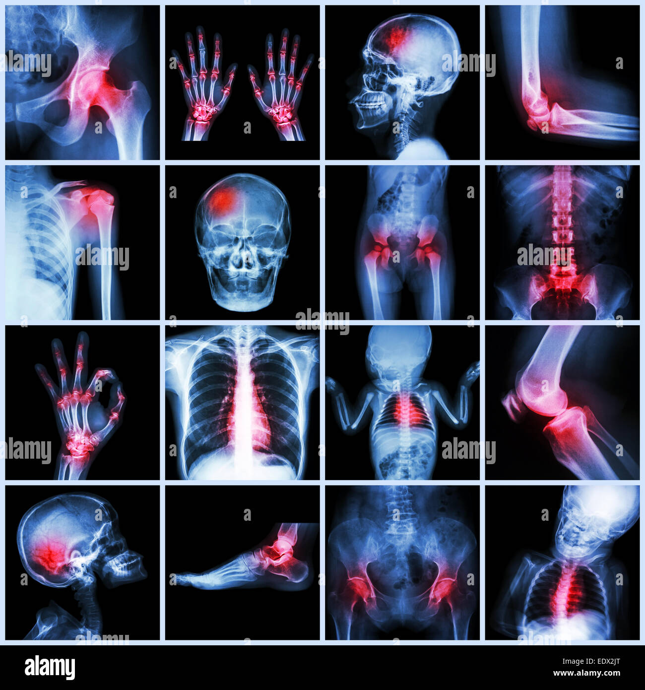 Collection X-ray partie multiples des droits de l'arthrite et la goutte (maladie,plusieurs , la polyarthrite rhumatoïde, la maladie de coeur congénitale,course) Banque D'Images