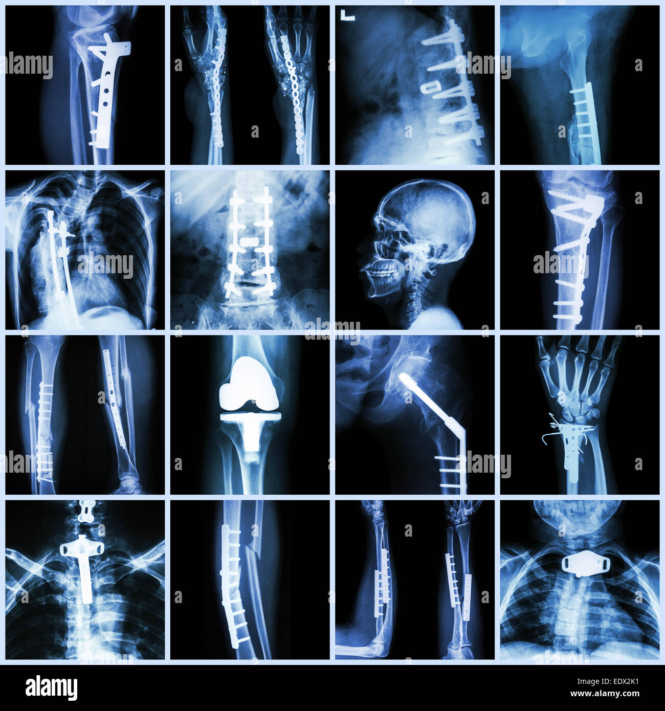 Collection X-ray la chirurgie orthopédique (plusieurs partie de l'exploitation, et la fixation interne par vis-plaque ) Banque D'Images