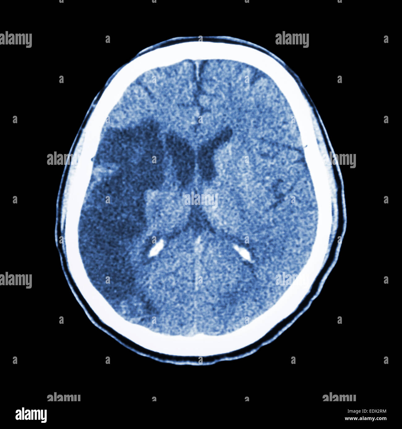 Tc brain : spectacle d'un accident vasculaire cérébral ischémique (hypodensite au-frontal droit lobe pariétal) Banque D'Images