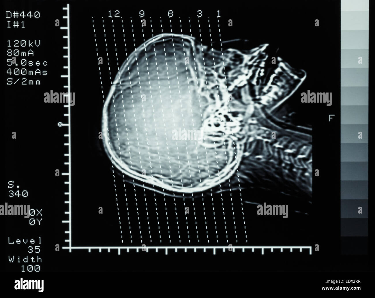 Scanner de film (Computed tomography) cerveau : voir la section sur le crane de ligne Banque D'Images