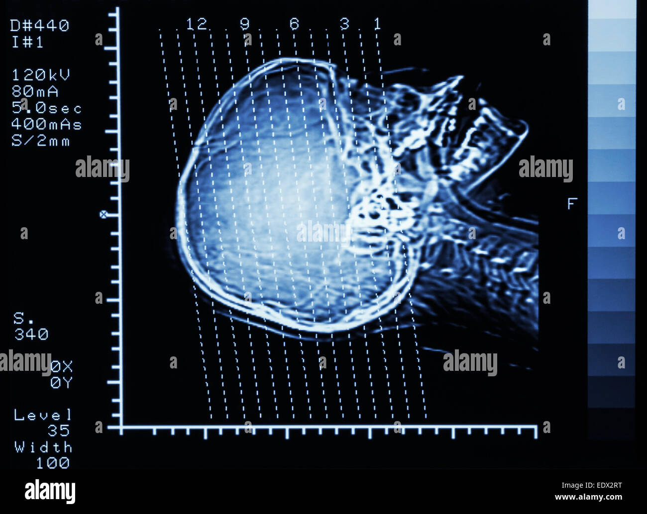 Scanner de film (Computed tomography) cerveau : voir la section sur le crane de ligne Banque D'Images