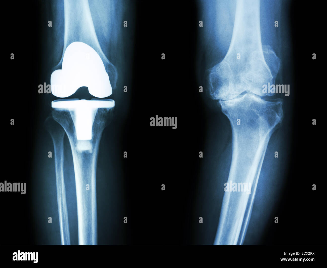 Film x-ray de l'arthrose du genou genou articulation artificielle et patient Banque D'Images
