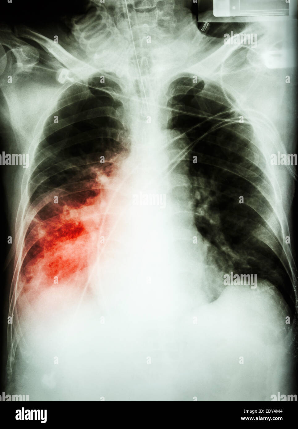 'Pneumonie avec défaillance respiratoire' film radiographie pulmonaire de patient avec un tube endotrachéal cathéter,. Il a été soigné à l'ICU. Banque D'Images