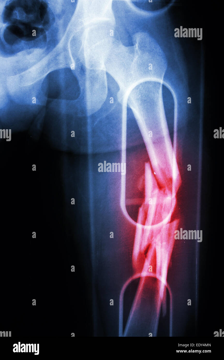 Film X-ray show comminute de l'arbre d'une fracture du fémur (os de la ...