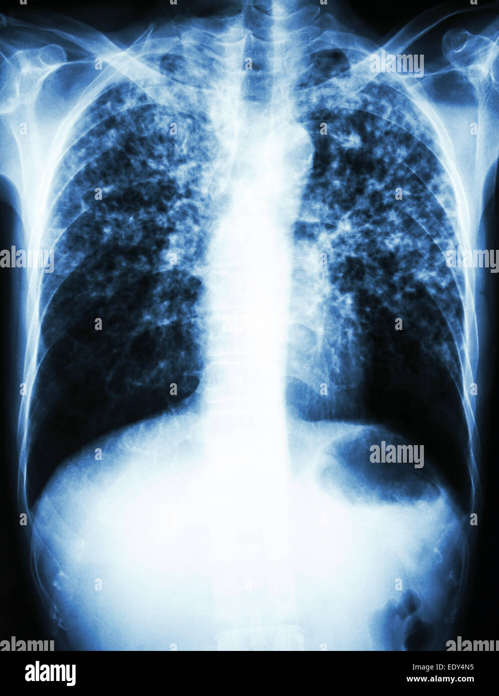 Film radiographie pulmonaire interstitielle pulmonaire montrent tant d'infiltrer en raison de l'infection à Mycobacterium tuberculosis (tuberculose pulmonaire) Banque D'Images