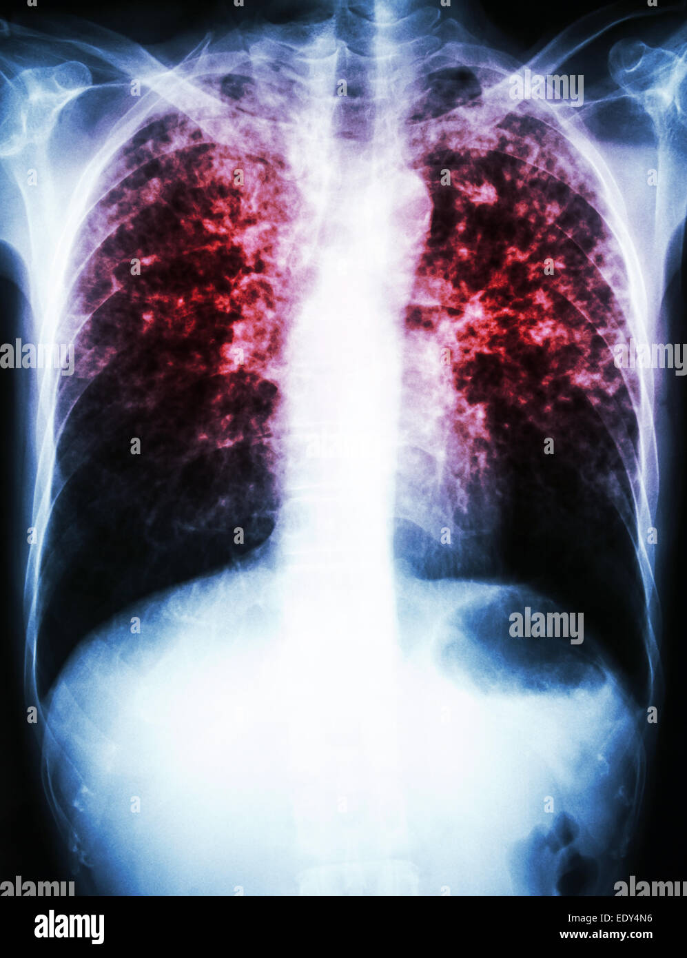 Film radiographie pulmonaire interstitielle pulmonaire montrent tant d'infiltrer en raison de l'infection à Mycobacterium tuberculosis (tuberculose pulmonaire) Banque D'Images