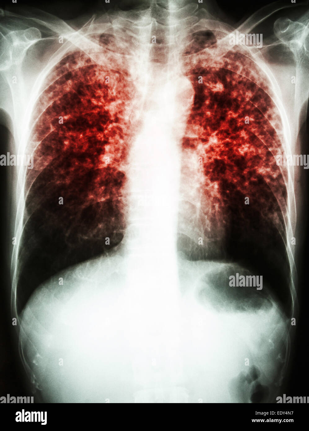 Film radiographie pulmonaire interstitielle pulmonaire montrent tant d'infiltrer en raison de l'infection à Mycobacterium tuberculosis (tuberculose pulmonaire) Banque D'Images