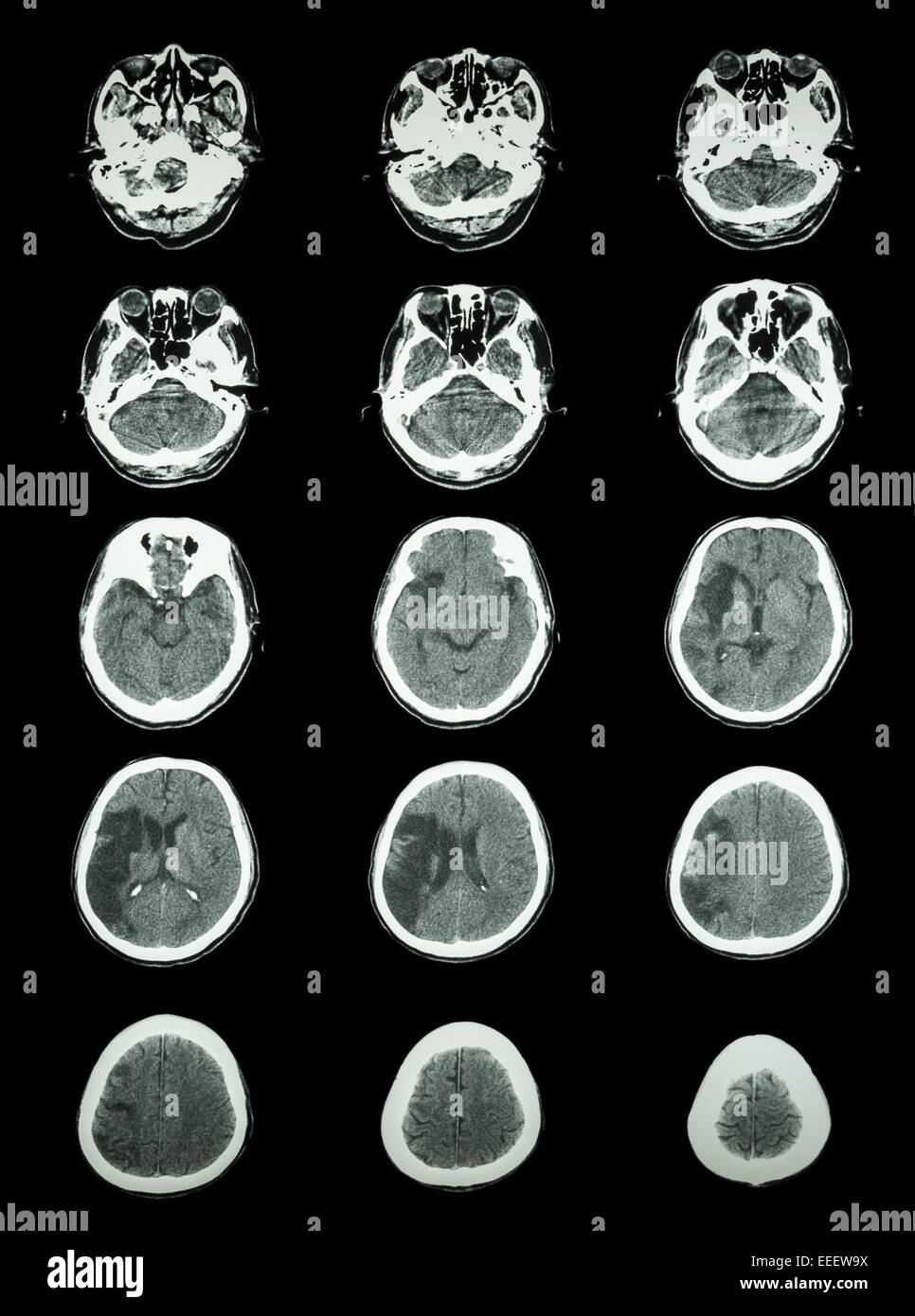 La tomodensitométrie (CT scan) de l'infarctus cérébral cerveau indiquent au-temporal droit lobe pariétal ( AVC ischémique ) Banque D'Images