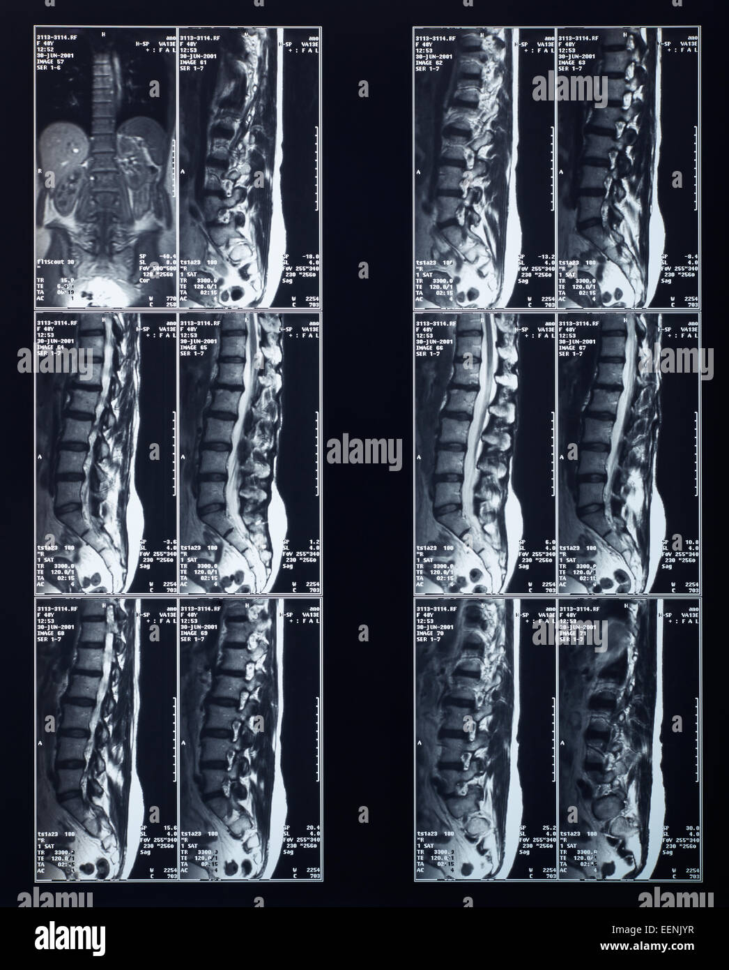 X-ray radiographie du rachis Banque D'Images