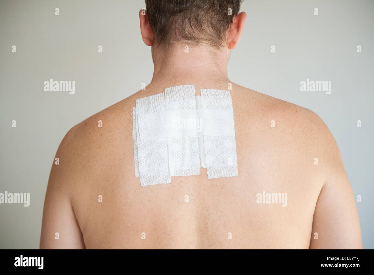 Homme nu de retour avec test d'allergie de contact dans le plâtre adhésif blanc Banque D'Images